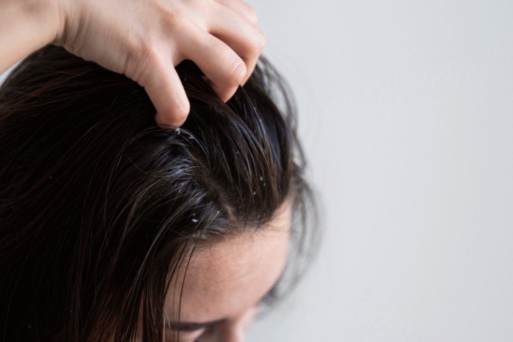 Dandruff Treatment in Pune