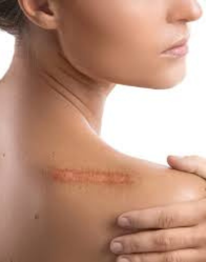 Laser Scar Reduction