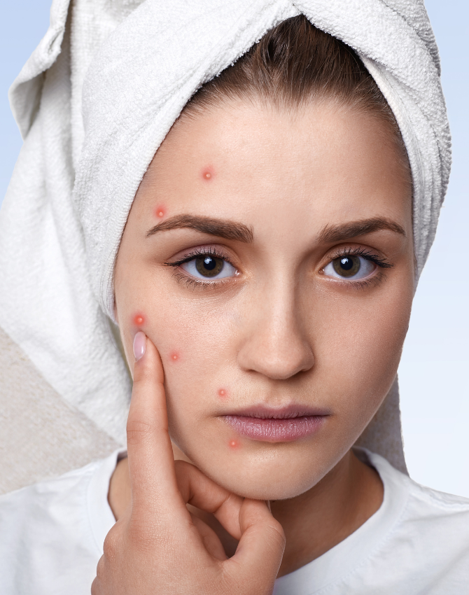 Laser Acne & Scar Reduction Treatment Pune